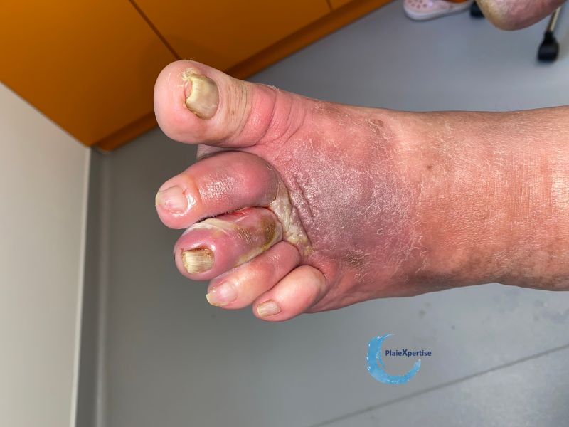 Fichier:Pied infecté29.jpg