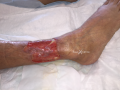Tendon normal26.png