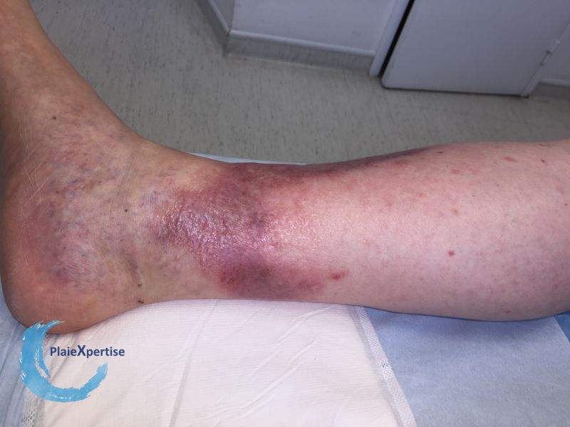 Fichier:Nécrobiose lipoïdique21.jpg