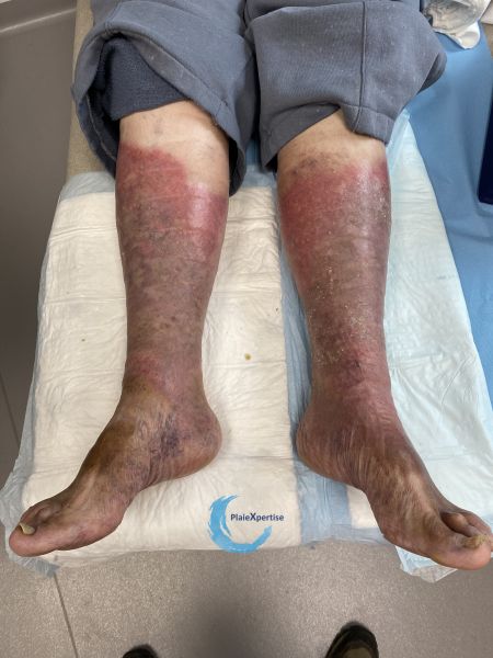 Fichier:Dermiteocre81.jpg
