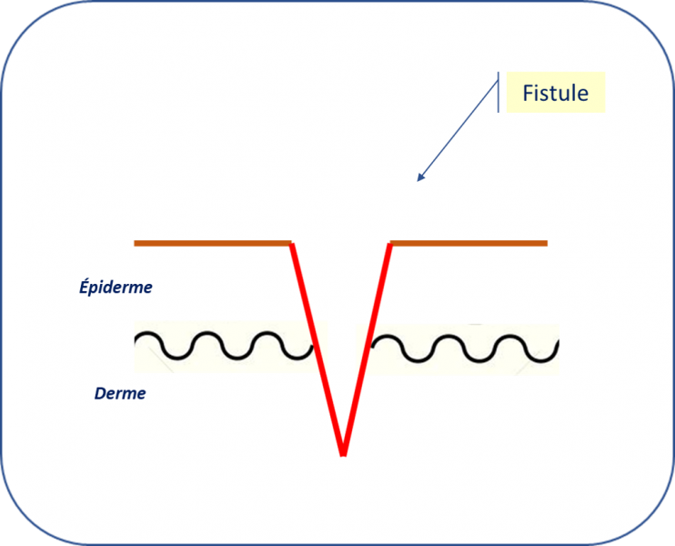 Fichier:Fistule.png