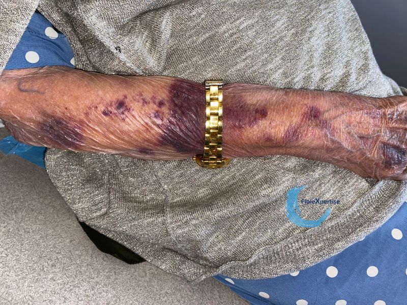 Fichier:Dermatoporose50.jpg