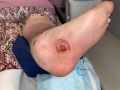 Pied de Charcot44.jpg