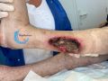 Tendon nécrotique humide62.jpg