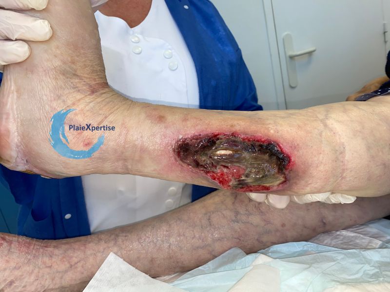 Fichier:Tendon nécrotique humide62.jpg