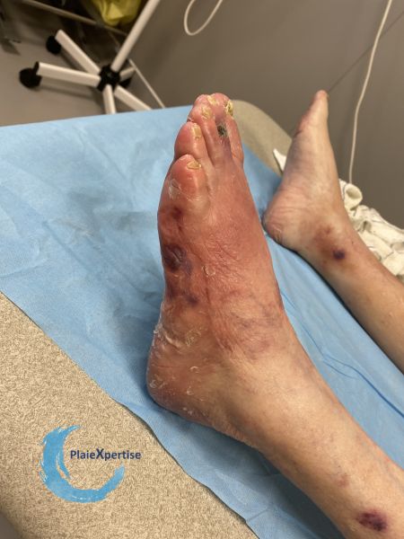 Fichier:Erythrocyanose15.jpg