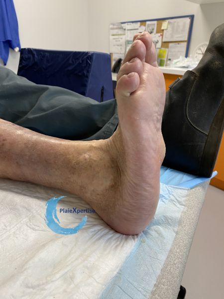 Fichier:Pied de Charcot20.jpg