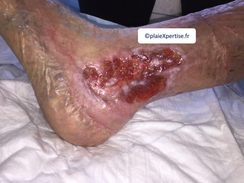 Fichier:Tissu de granulation normal8.png