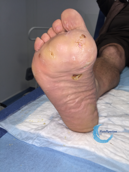 Fichier:Pied de Charcot11.png