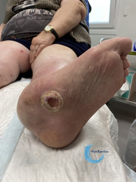 Fichier:Pied de Charcot37.jpg