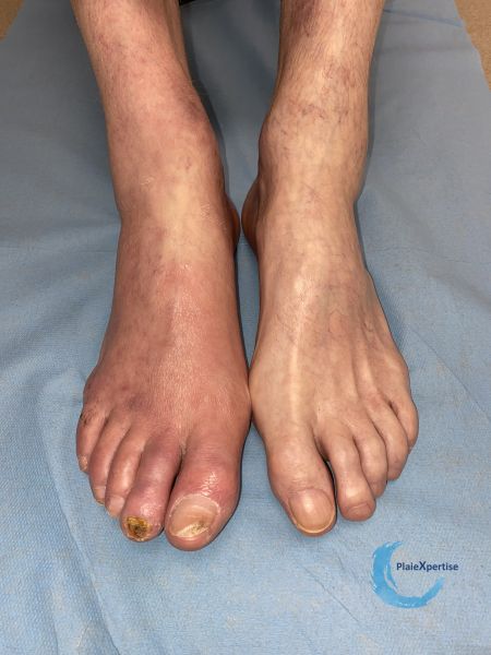 Fichier:Erythrocyanose22.jpg