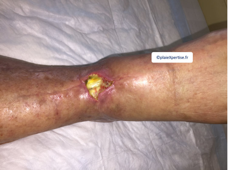 Fichier:Tendon normal21.png