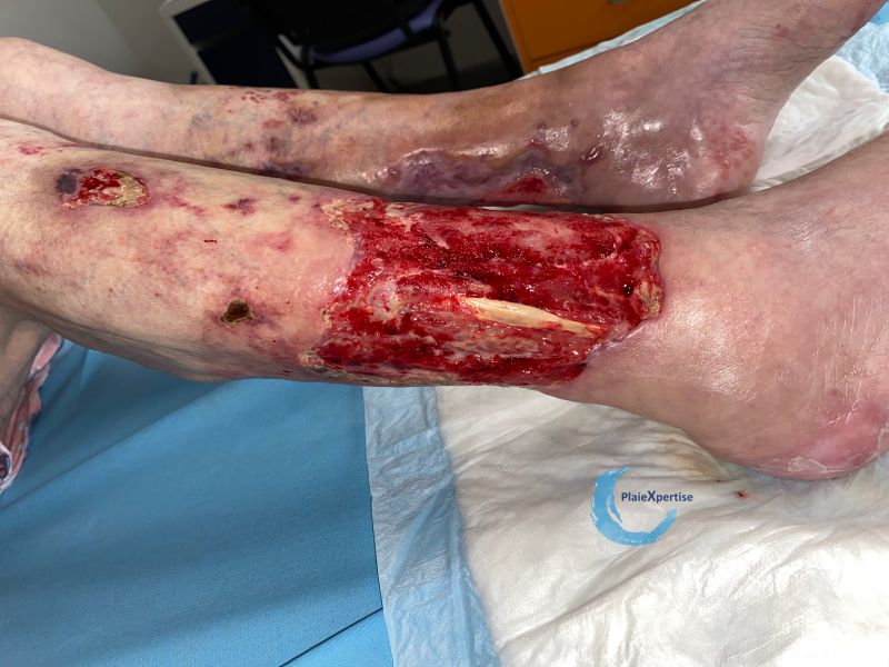 Fichier:Tendon normal46.jpg