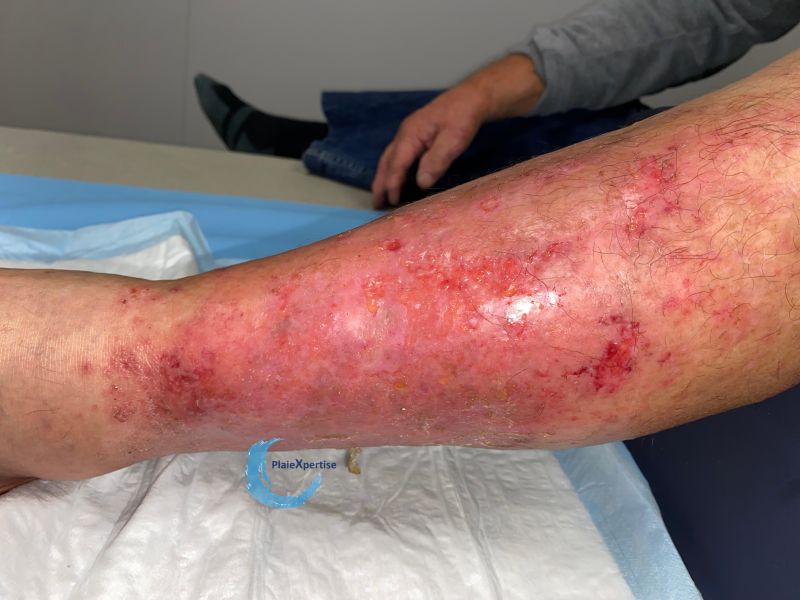 Fichier:Eczéma150.jpg