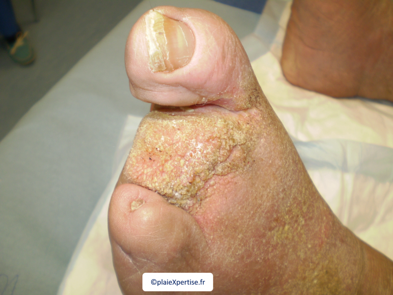 Fichier:Lymphoedème pied8.png