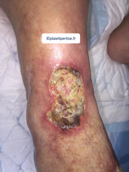 Fichier:Tendon nécrotique humide28.png