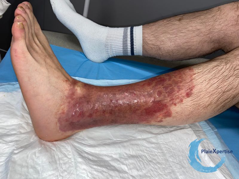 Fichier:Eczéma115.jpg