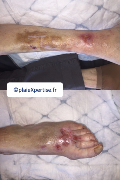 Fichier:Pemphigoïde6.png