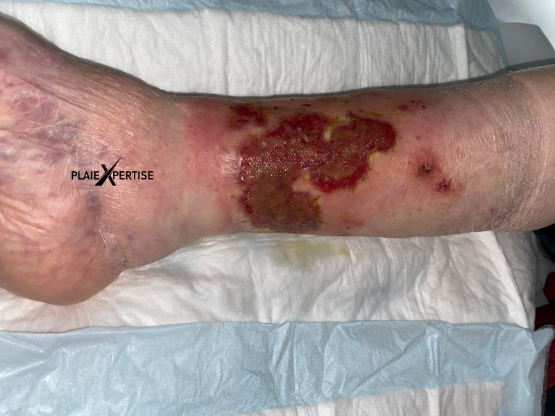 Fichier:Tissu de granulation inflammatoire23.png