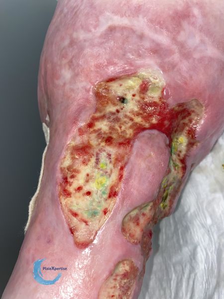 Fichier:Calcifications44.jpg
