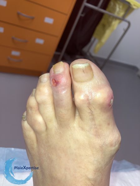 Fichier:Goutte et tophus35.jpg