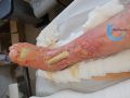 Tendon nécrotique humide47.jpg
