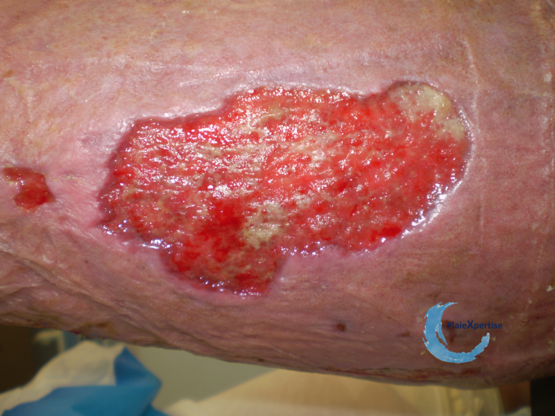 Fichier:Tissu de granulation normal45.png