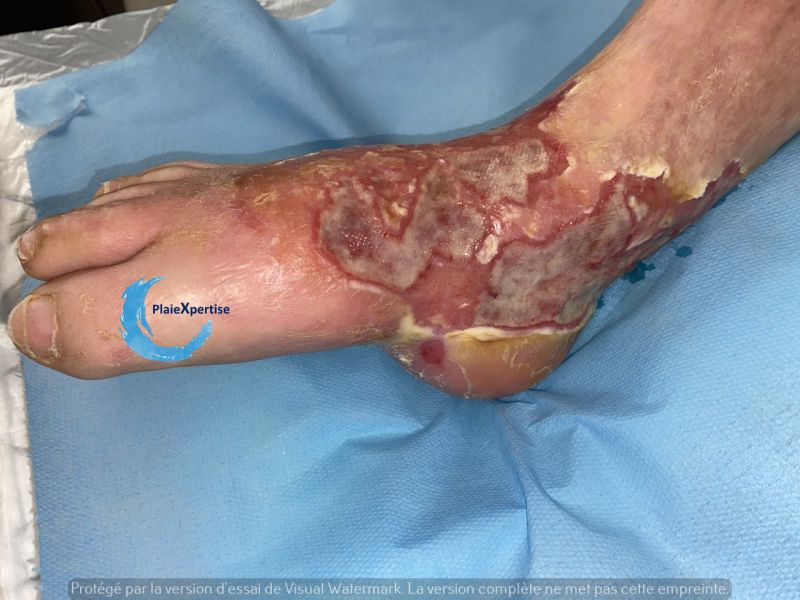 Fichier:Cou de pied108.jpg
