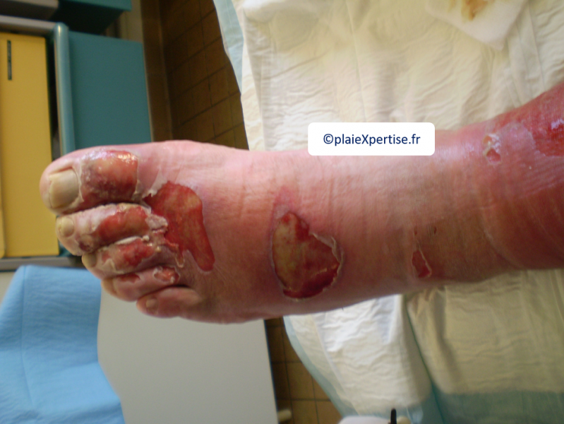 Fichier:Erosions post bulleuses3.png