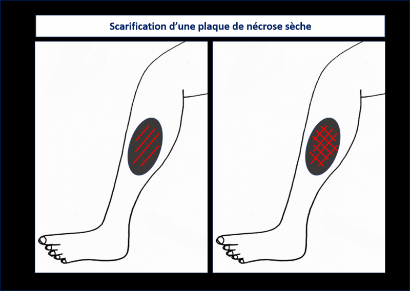 Fichier:Scarification.png