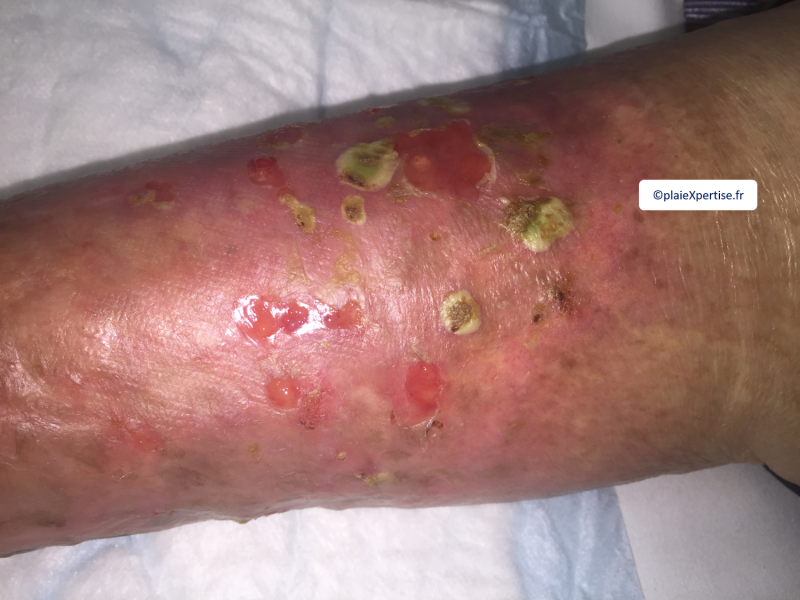 Fichier:Pustules4.png