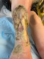 Tendon nécrotique humide72.jpg