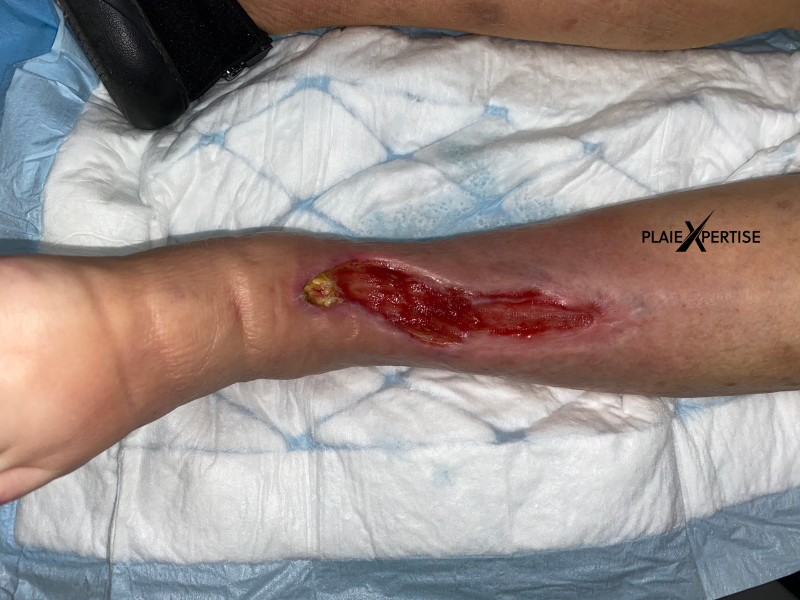 Fichier:Tissu de granulation normal31.png