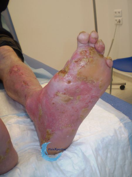 Fichier:Eczéma95.jpg