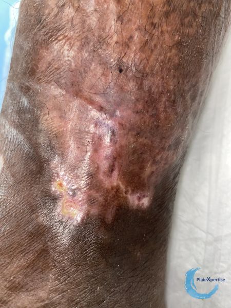 Fichier:Epidermisation15.jpg
