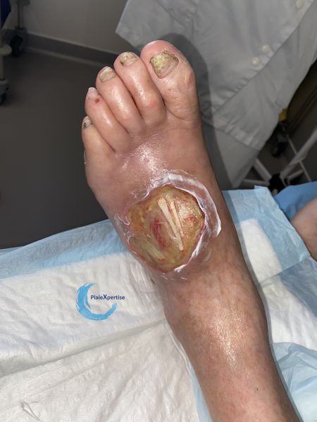 Fichier:Cou de pied92.jpg