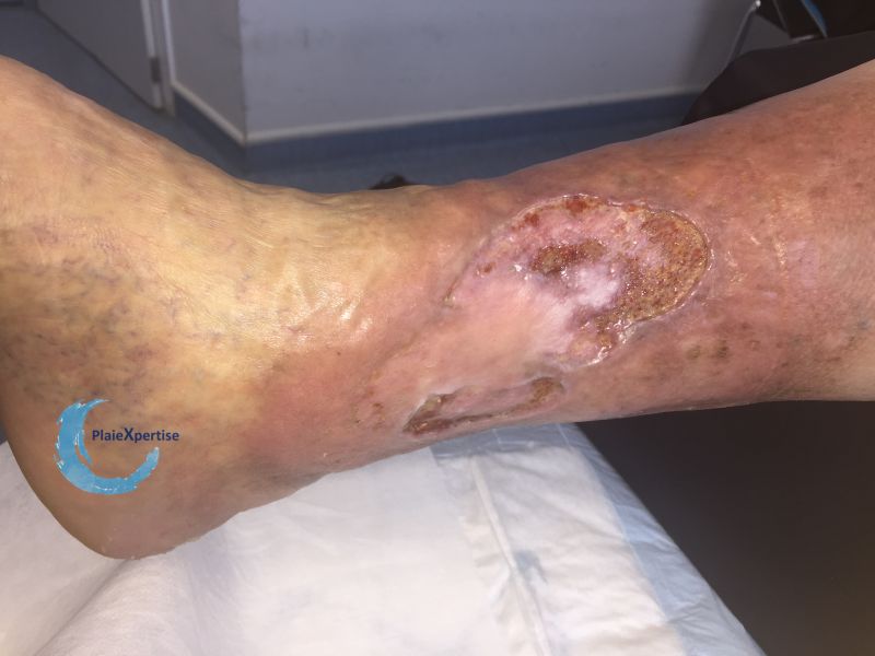 Fichier:Epidermisation8.jpg