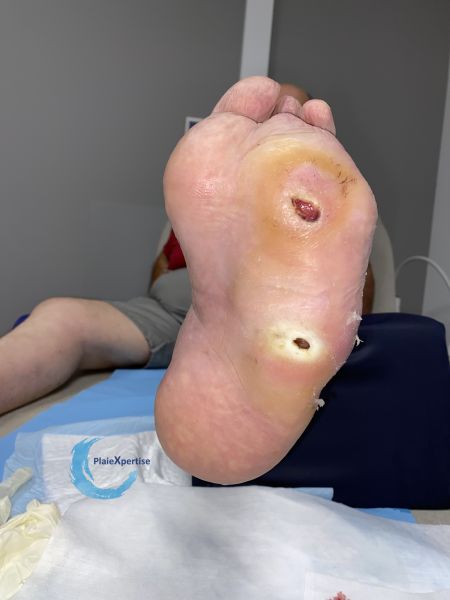 Fichier:Pied de Charcot36.jpg