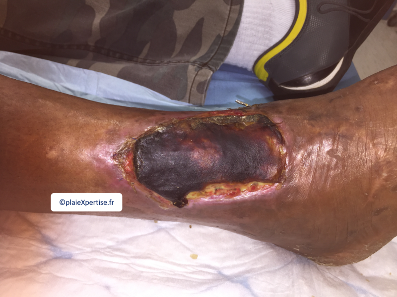 Fichier:Cou de pied8.png