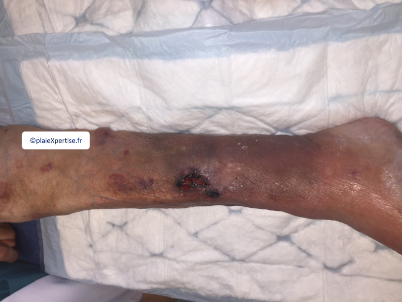Fichier:Dermatoporose8.png