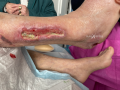 Tendon-Reliquat8.png