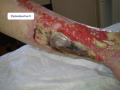 Tendon nécrotique humide6.png