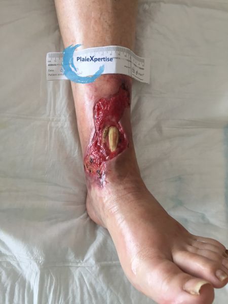 Fichier:Tendon nécrotique humide64.jpg