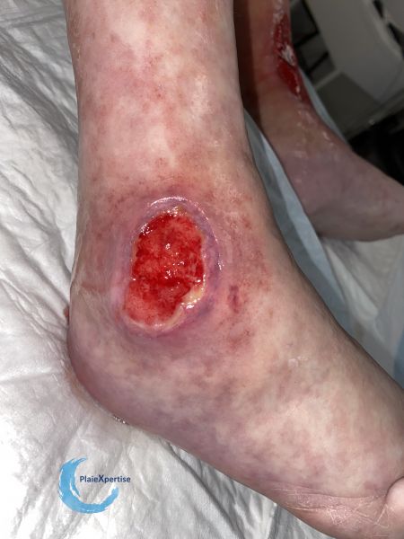 Fichier:Tissu de granulation normal63.jpg