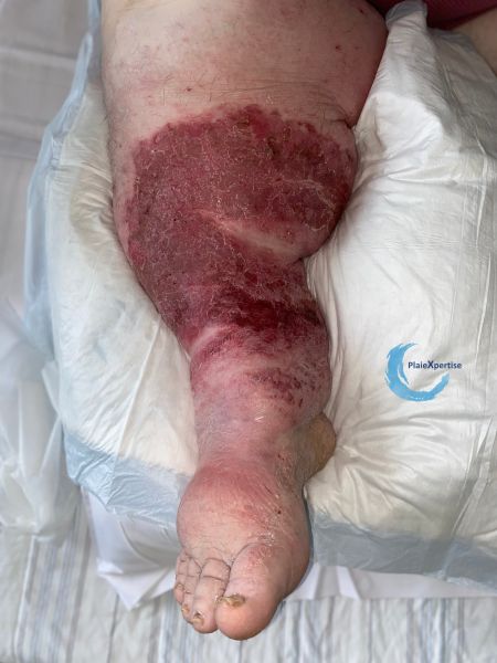Fichier:Eczéma147.jpg