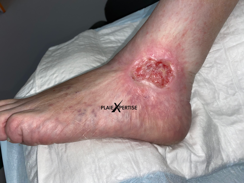 Fichier:Epidermisation3.png