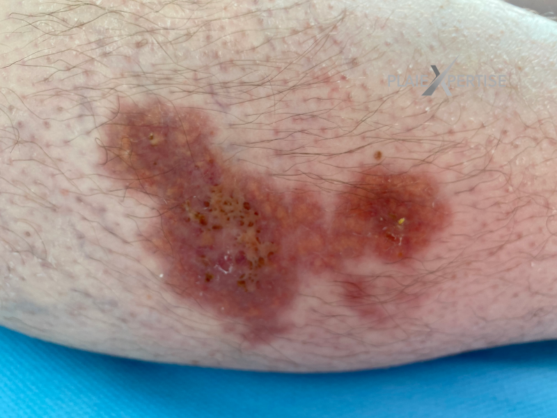 Fichier:Nécrobiose lipoïdique11.png