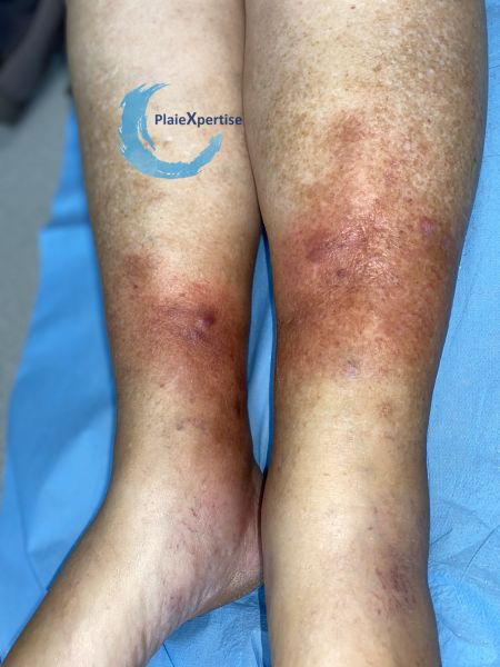 Fichier:Hypodermite chronique58.jpg
