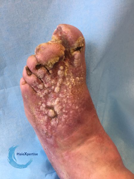 Fichier:Lymphoedème49.jpg