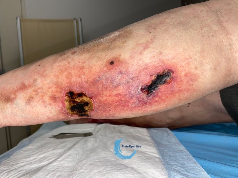 Fichier:Angiodermite typique136.jpg